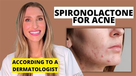 is 25 mg of spironolactone enough for acne|does spironolactone cause purging.